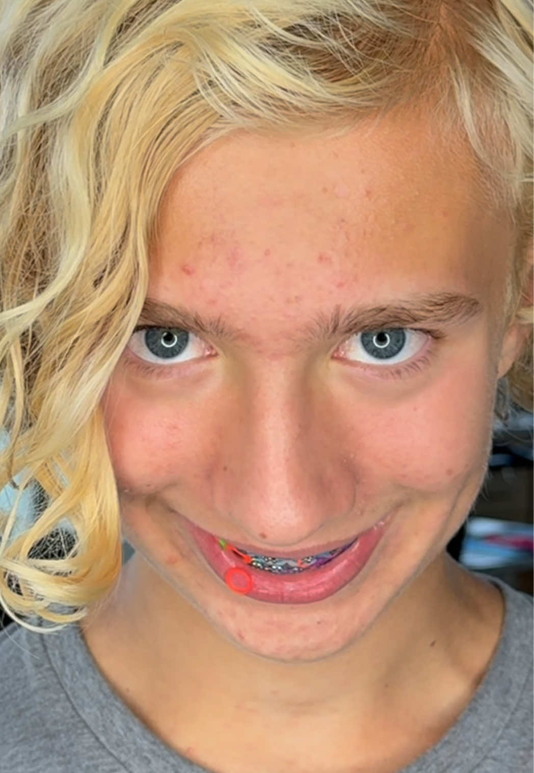 @The Braces Guy
