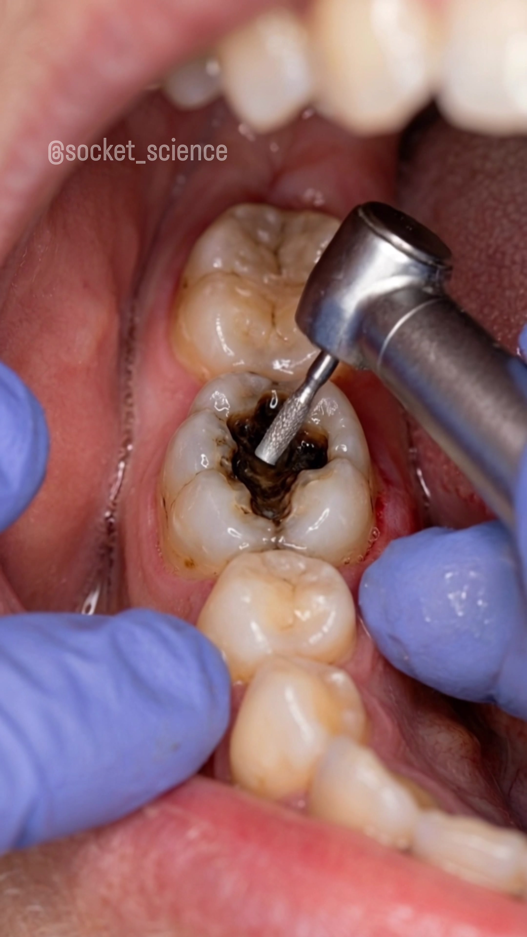 @Socket Science | Dental Visual