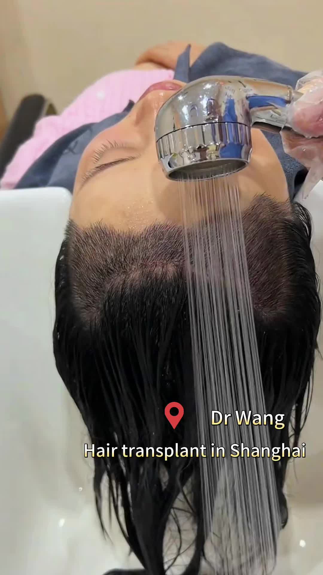 @HAIR TRANSPLANT WANG🇨🇳