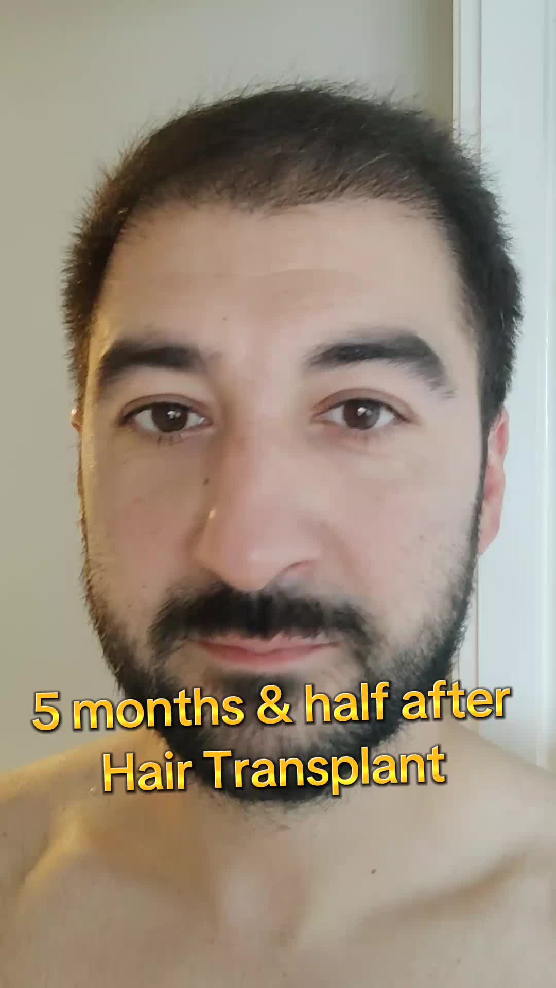 @My hair transplant