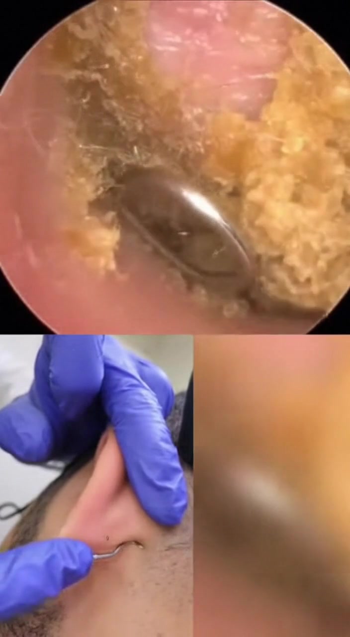 @Ear Cleaning