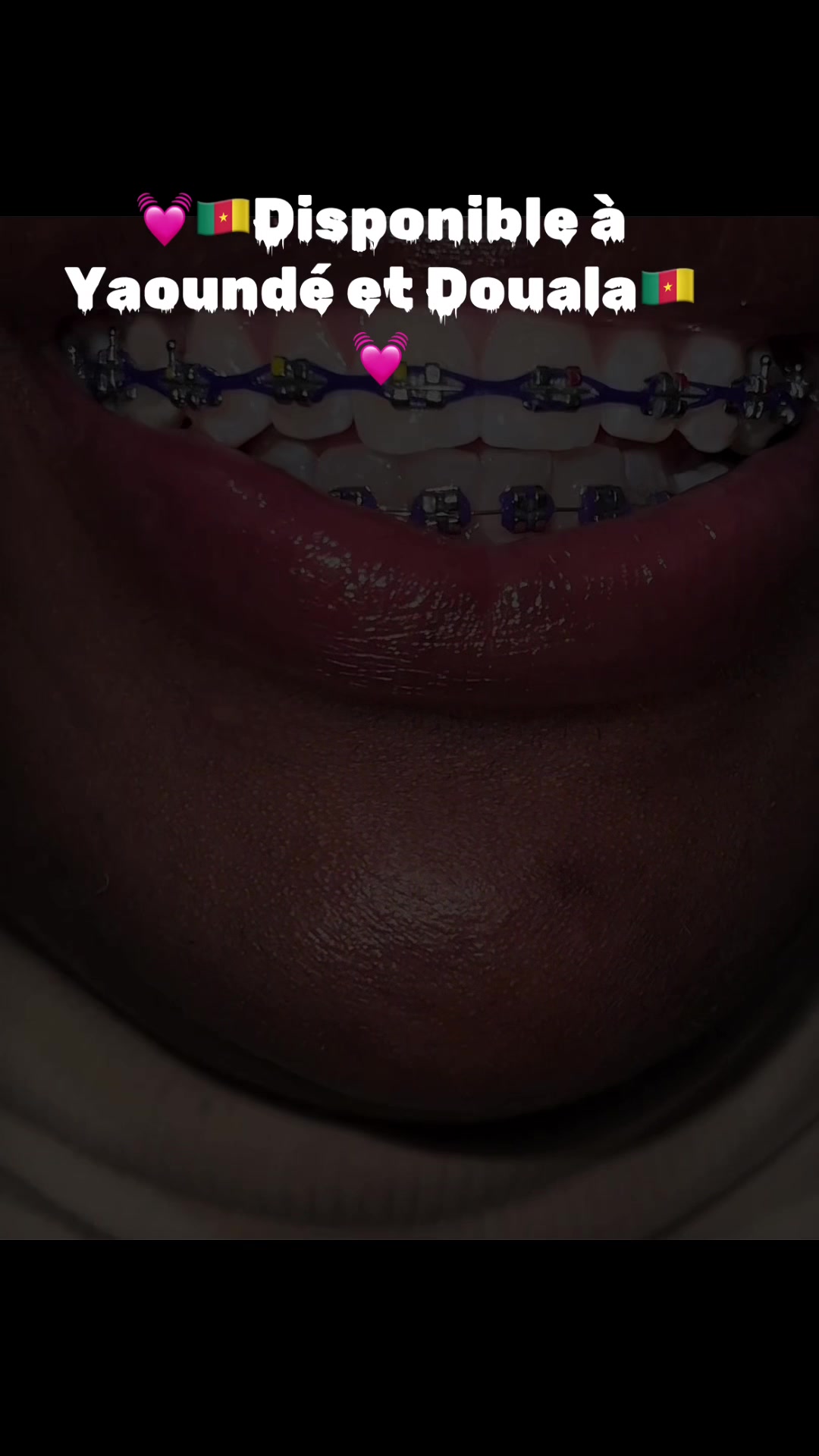 @MG BRACES
