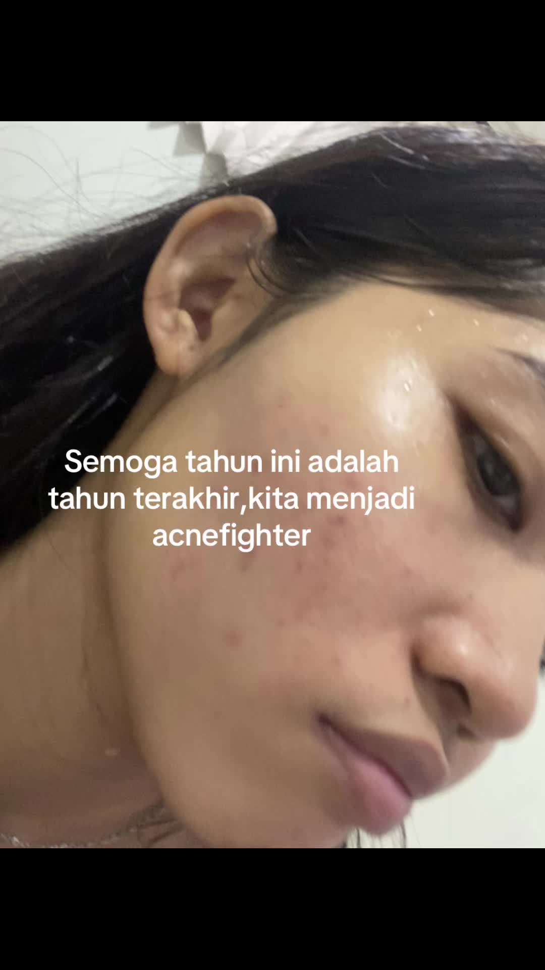 @acnefighter ew