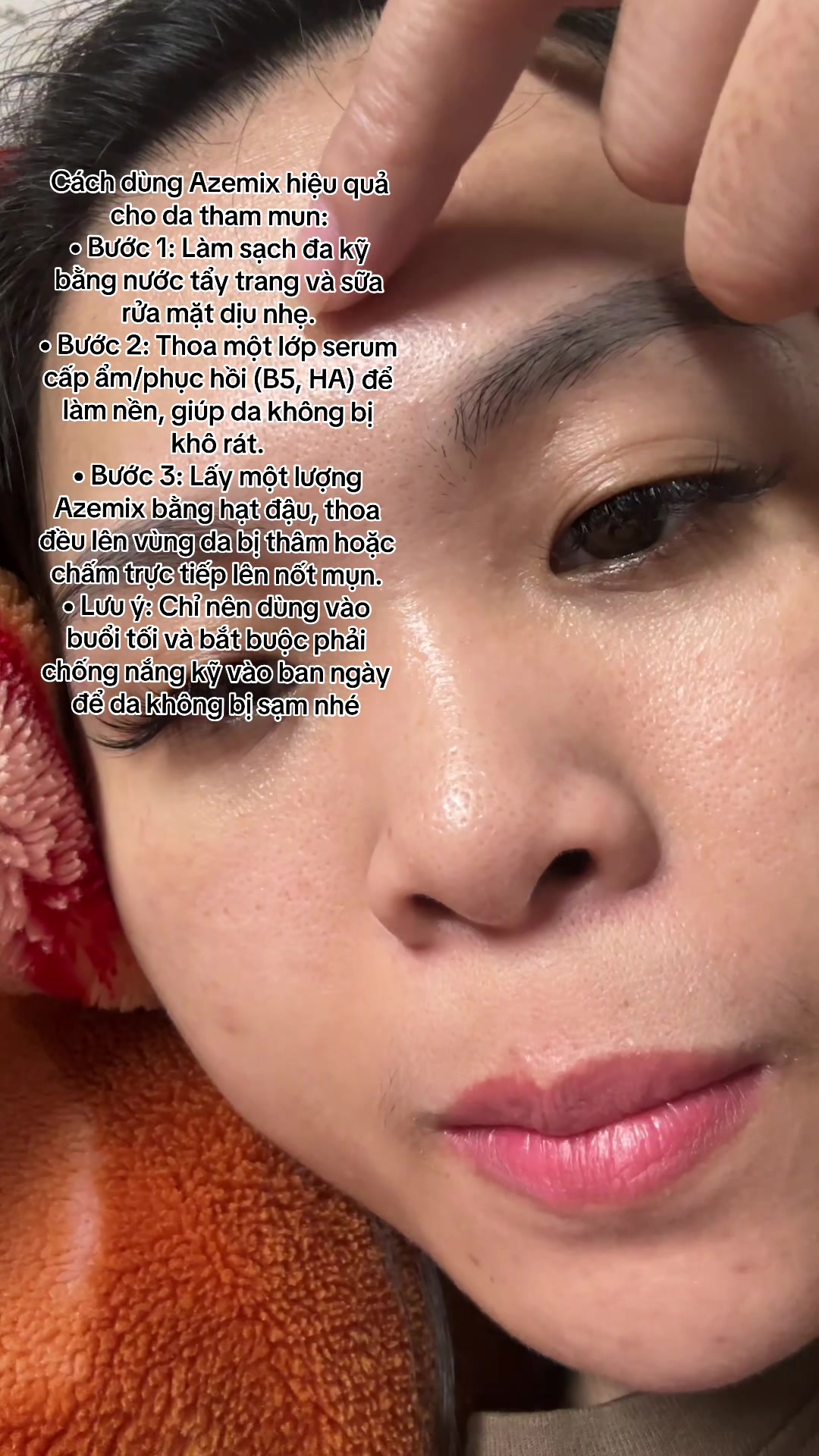 @Hoa Acne Skincare🌷
