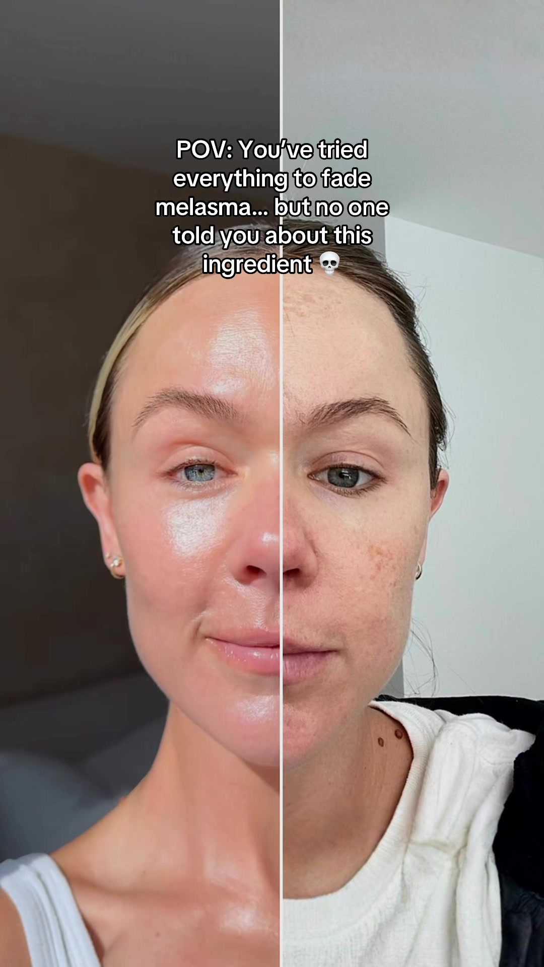 @Celeste | RN acne expert