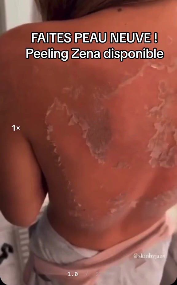 @peeling_zena