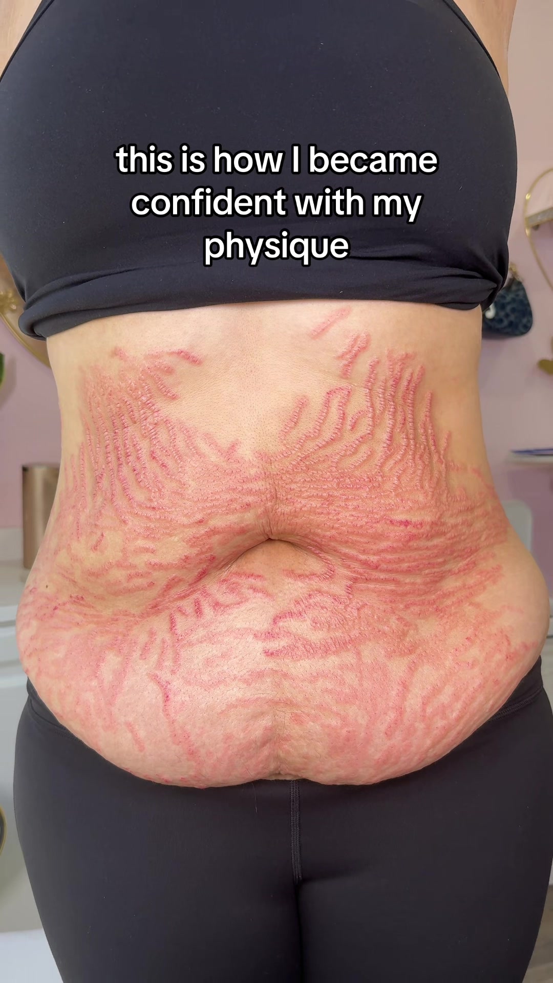 @Stretch Mark Fairy 🧚✨
