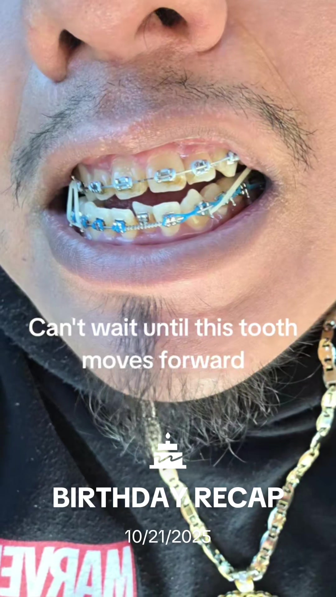 @str8braces