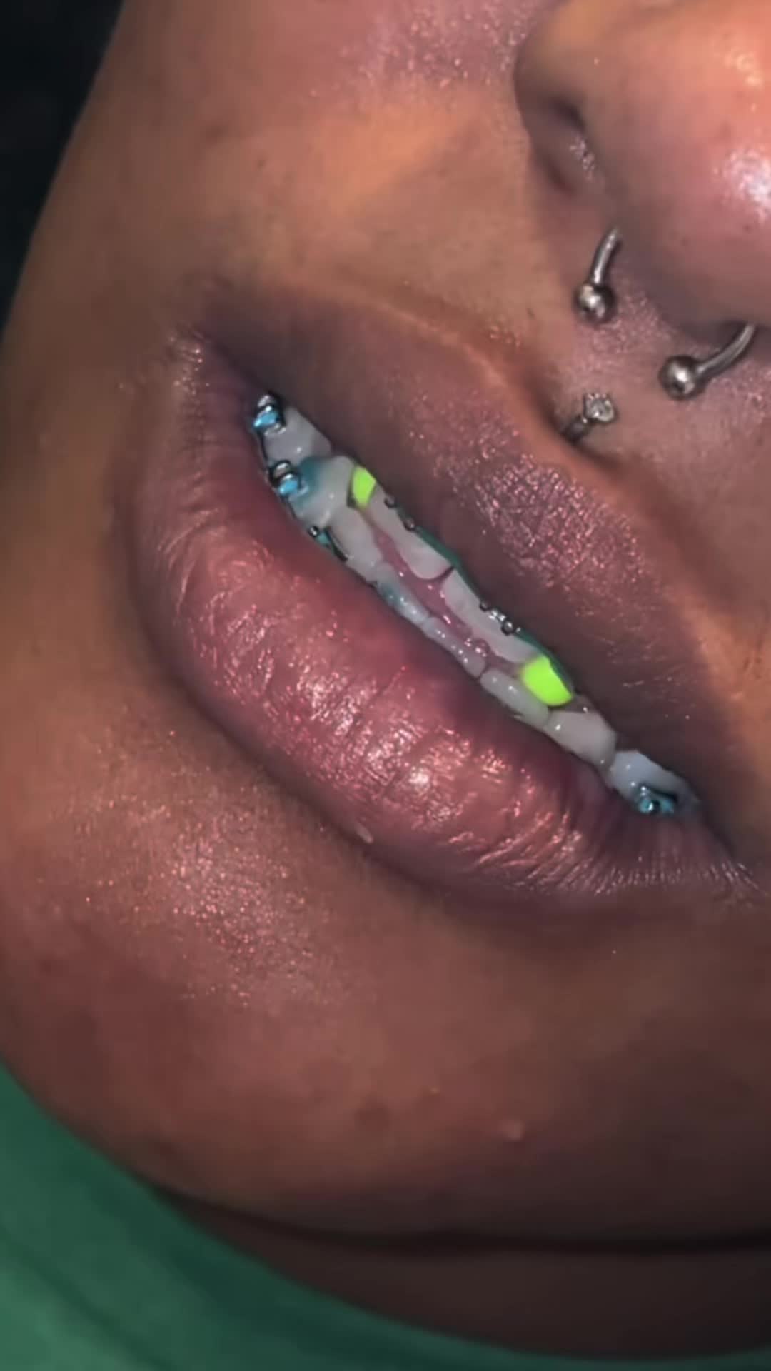 @bracesjunkie