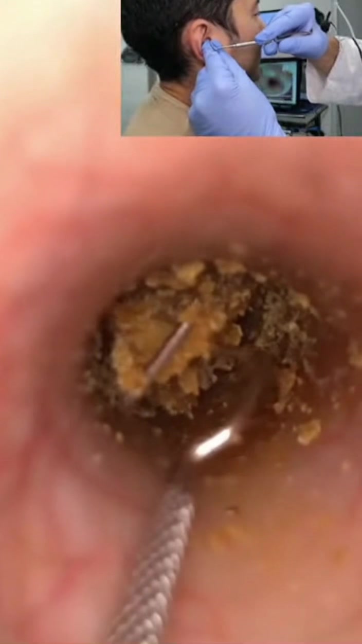 @Ear Cleaning