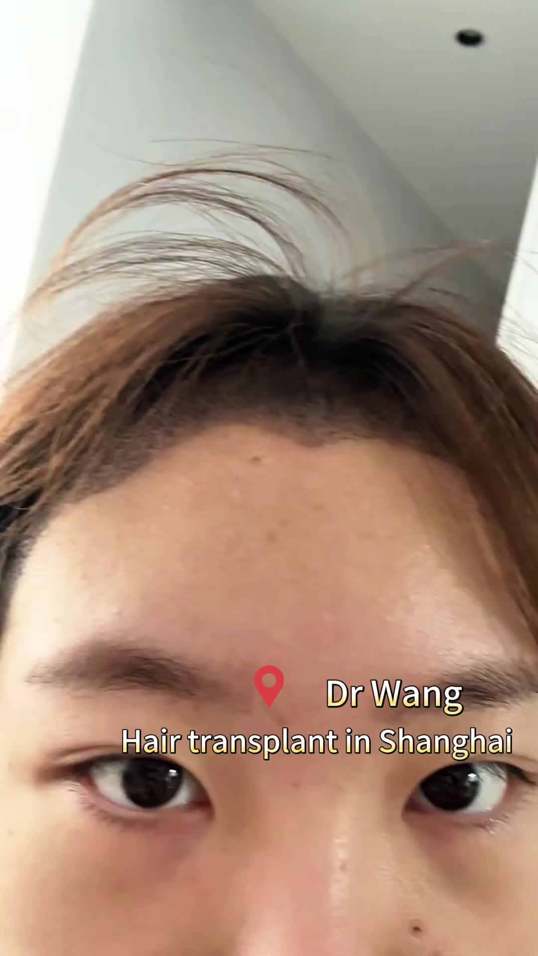@HAIR TRANSPLANT WANG🇨🇳