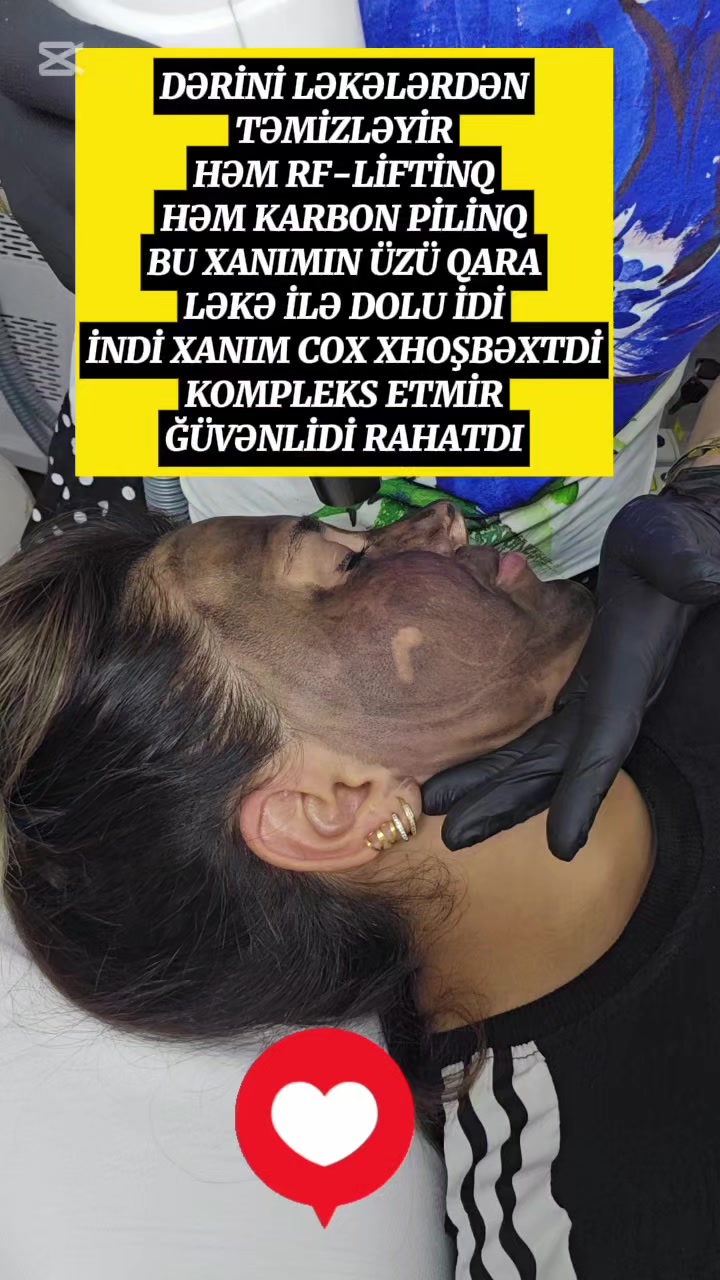 @ehmedli_kosmetoloq_lazeroloq
