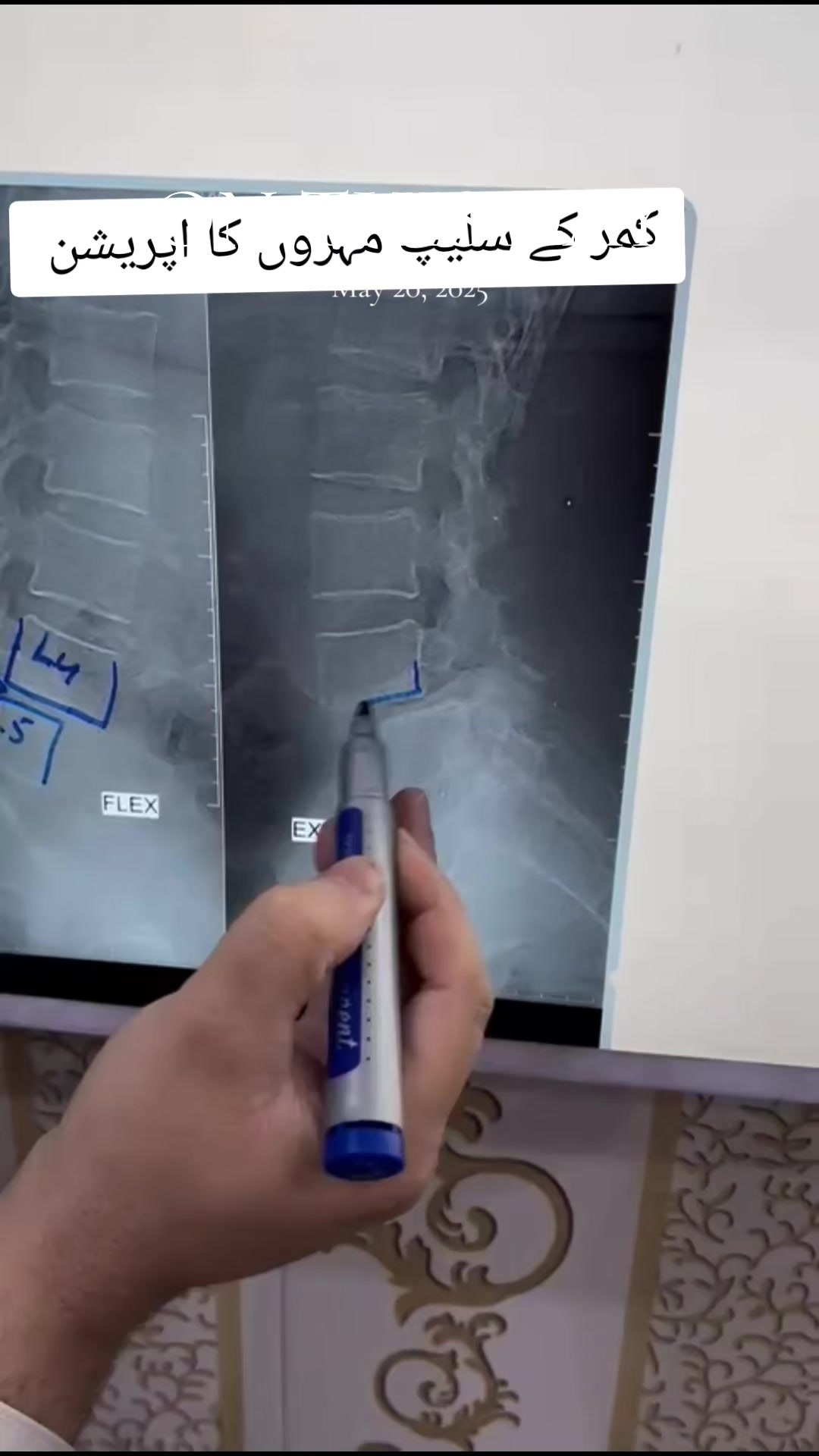 @@Dr.Ibrar Spine &Ortho Surgeon