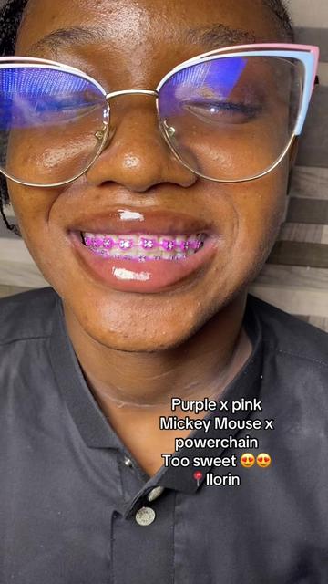 @Braces.bymavi|Smile Aesthetics