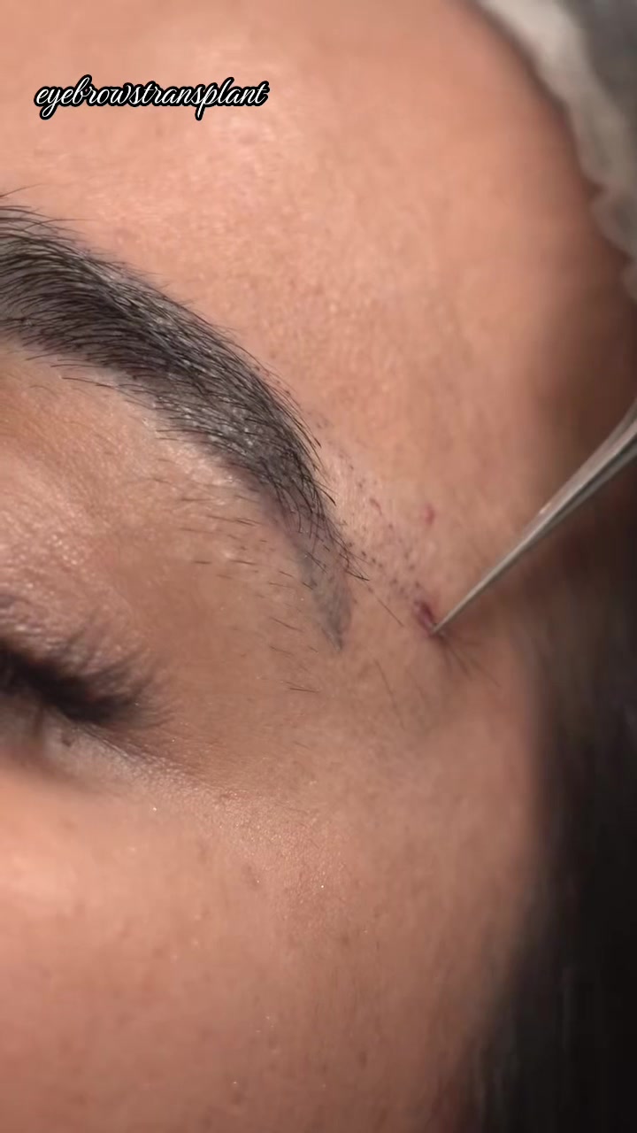 @Eyebrows Transplant