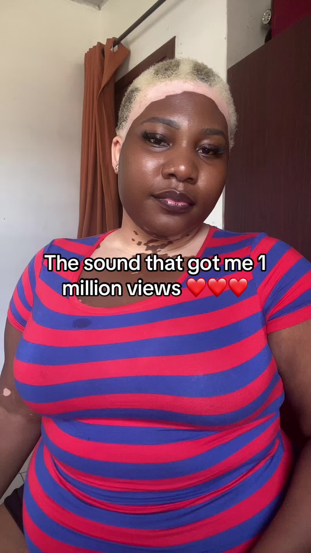 @Thevitiligogirl