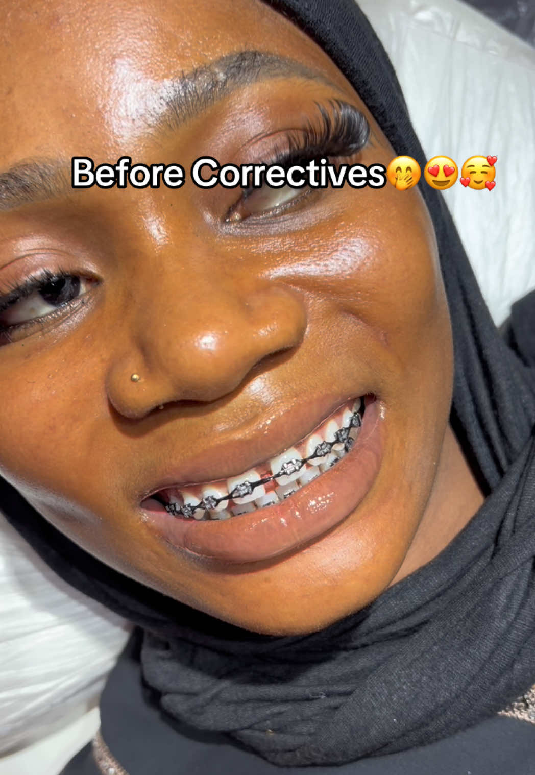 @Abuja Fashion Braces/Toothgems