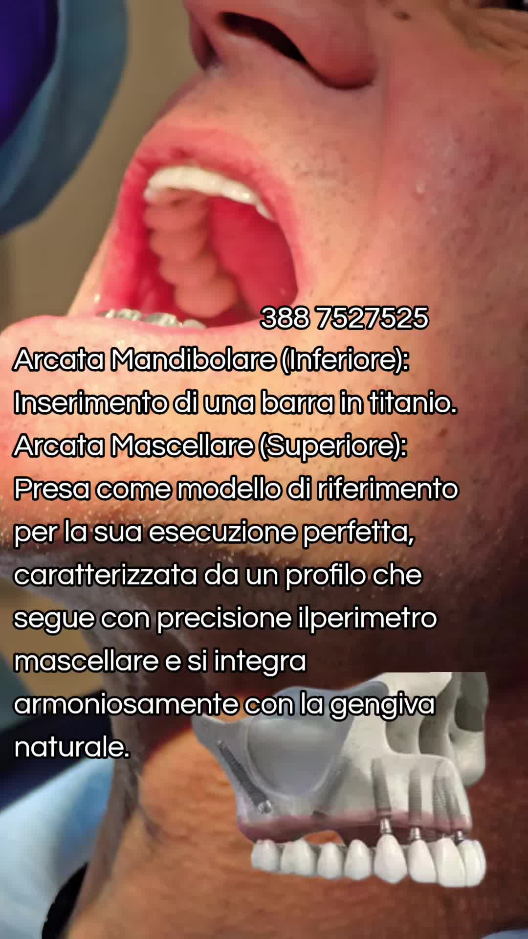 @Implantologiaprezzi
