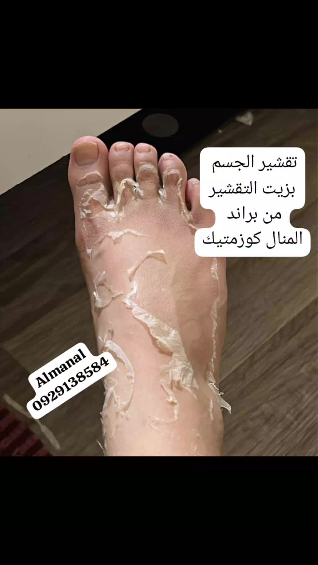 @drmanal " لعلاج التشققات "