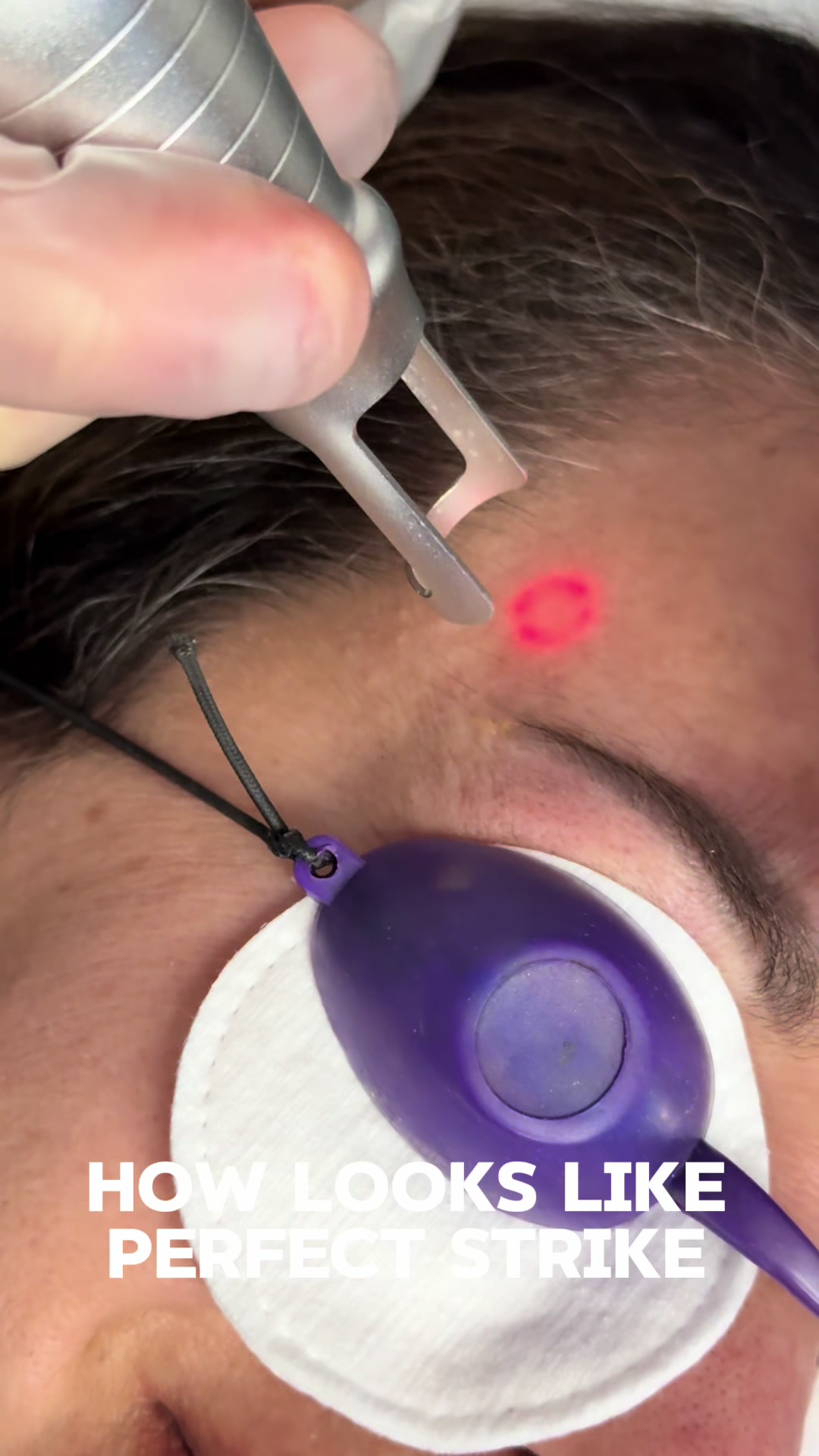 @Safe Eyebrows Tattoo Removal🗽