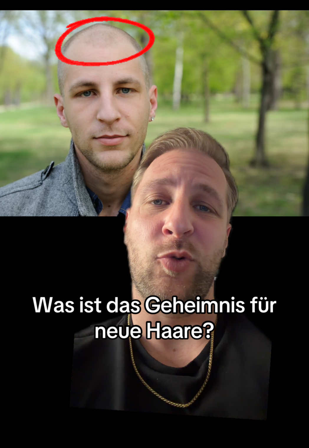 @Mr. Hairtransplant