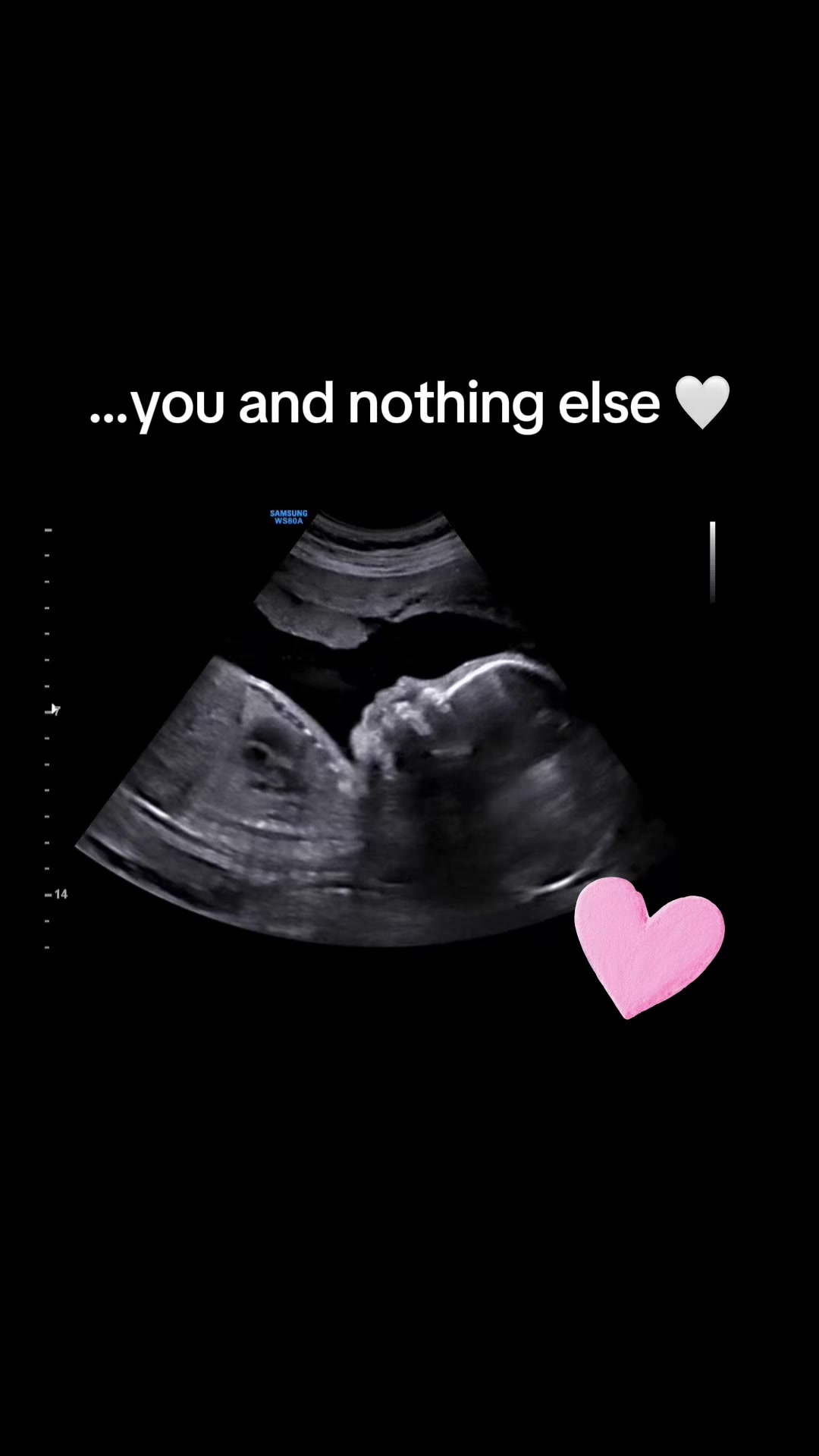@Loveatfirstsightultrasound