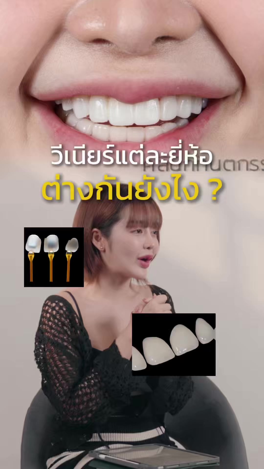 @หมอป่องสวยมาก veneer 🦷