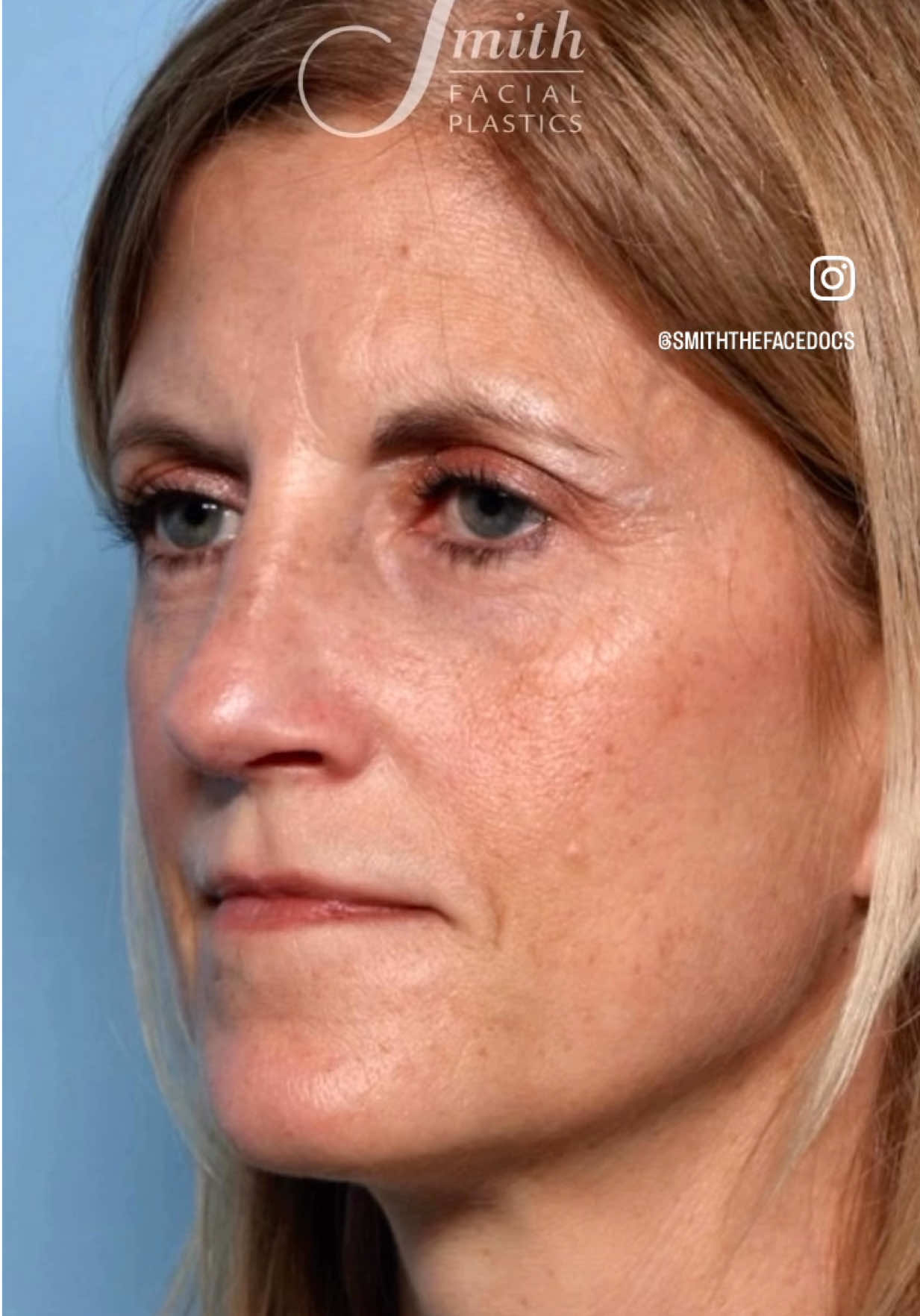 @Smith Facial Plastics