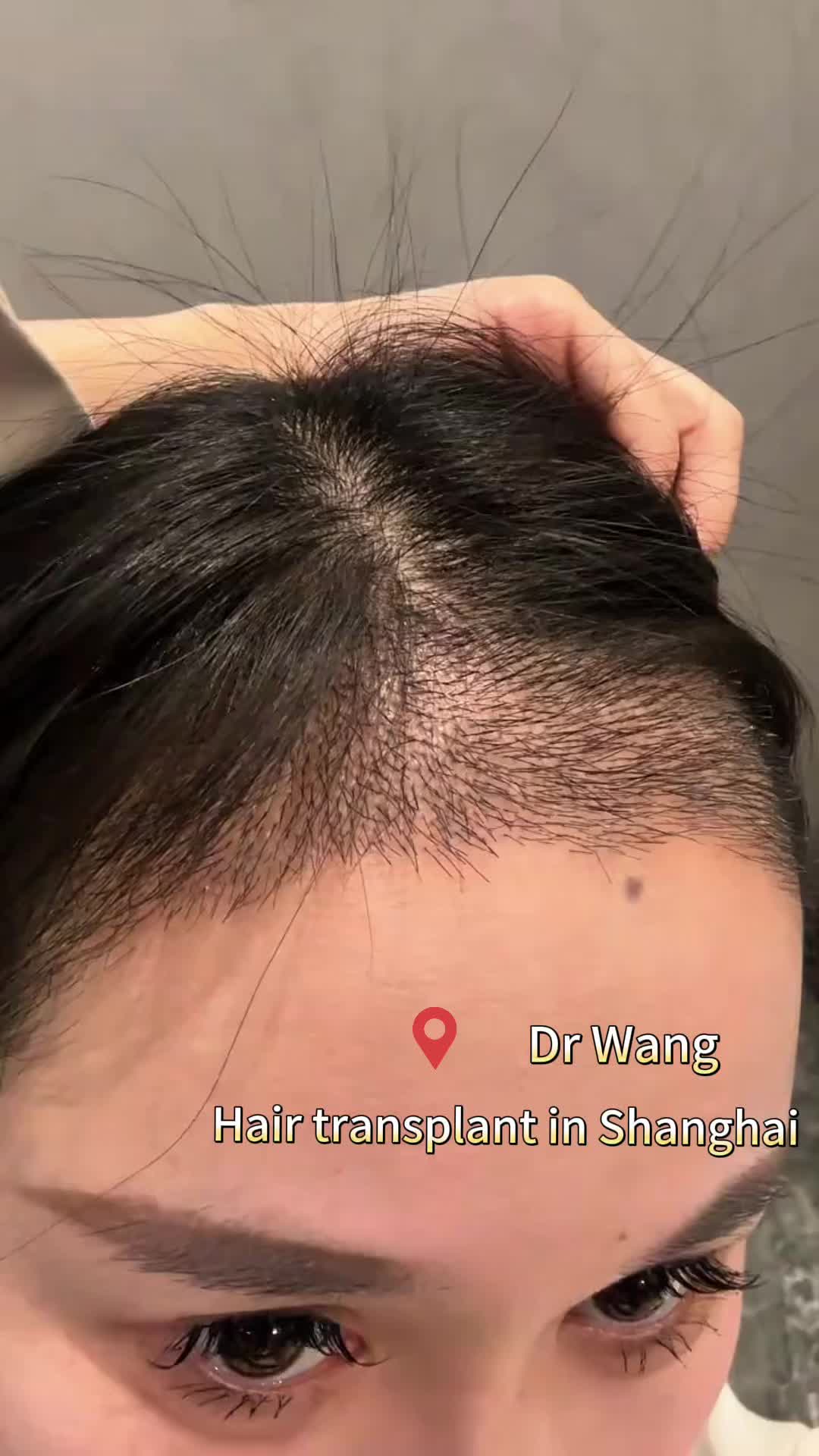 @HAIR TRANSPLANT WANG🇨🇳
