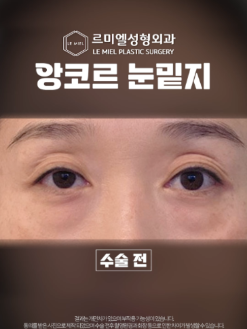 @르미엘성형외과