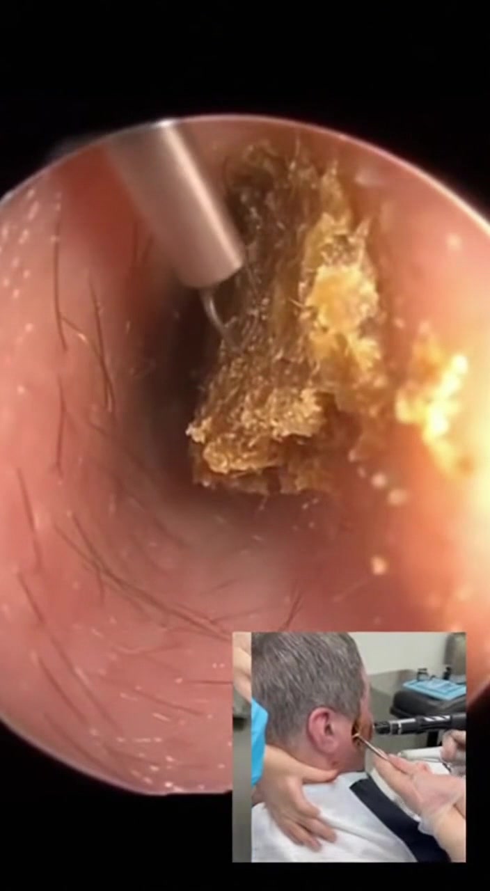 @Ear Cleaning