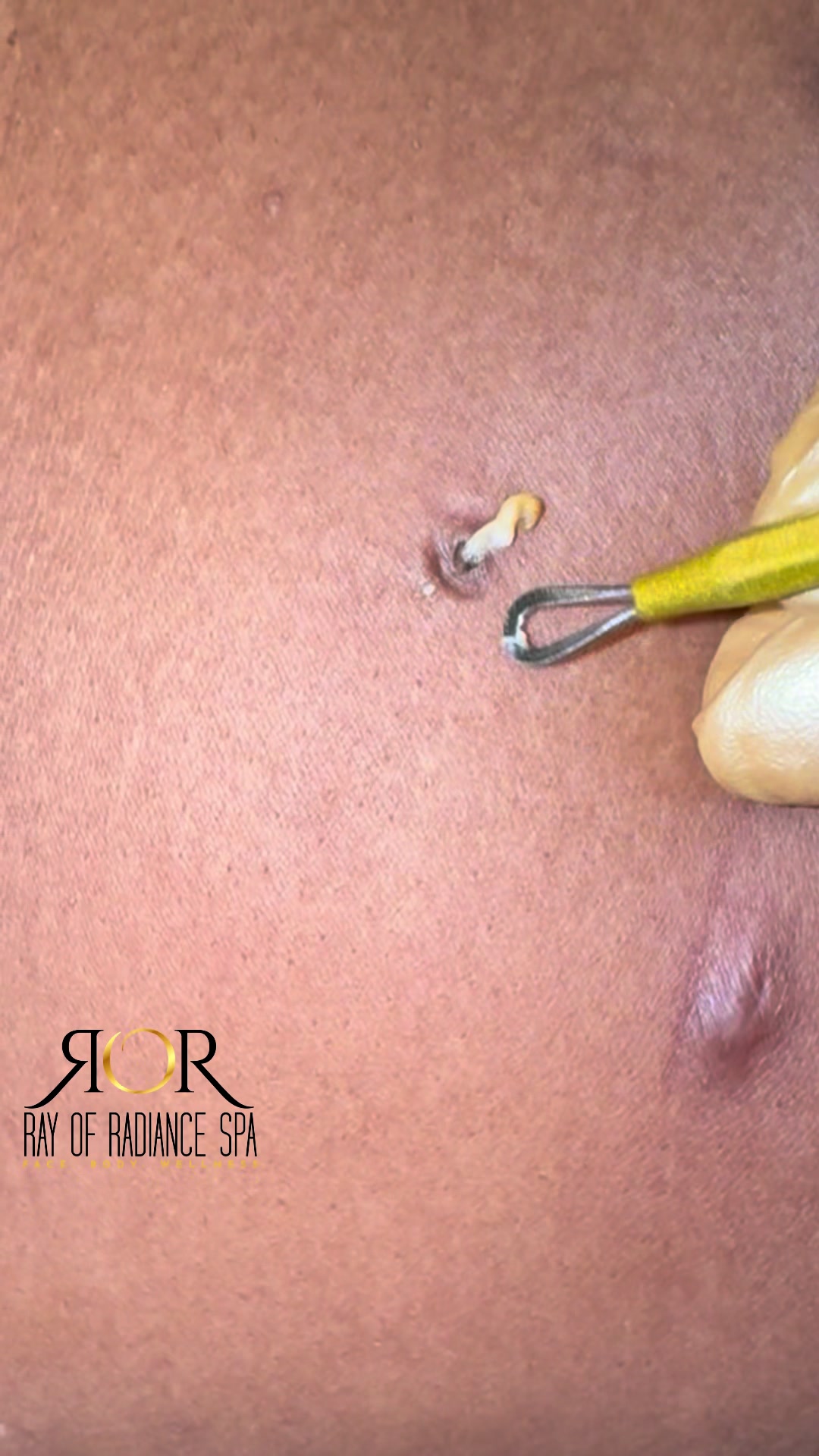 @Rosey-FL Esthetician/laserTech