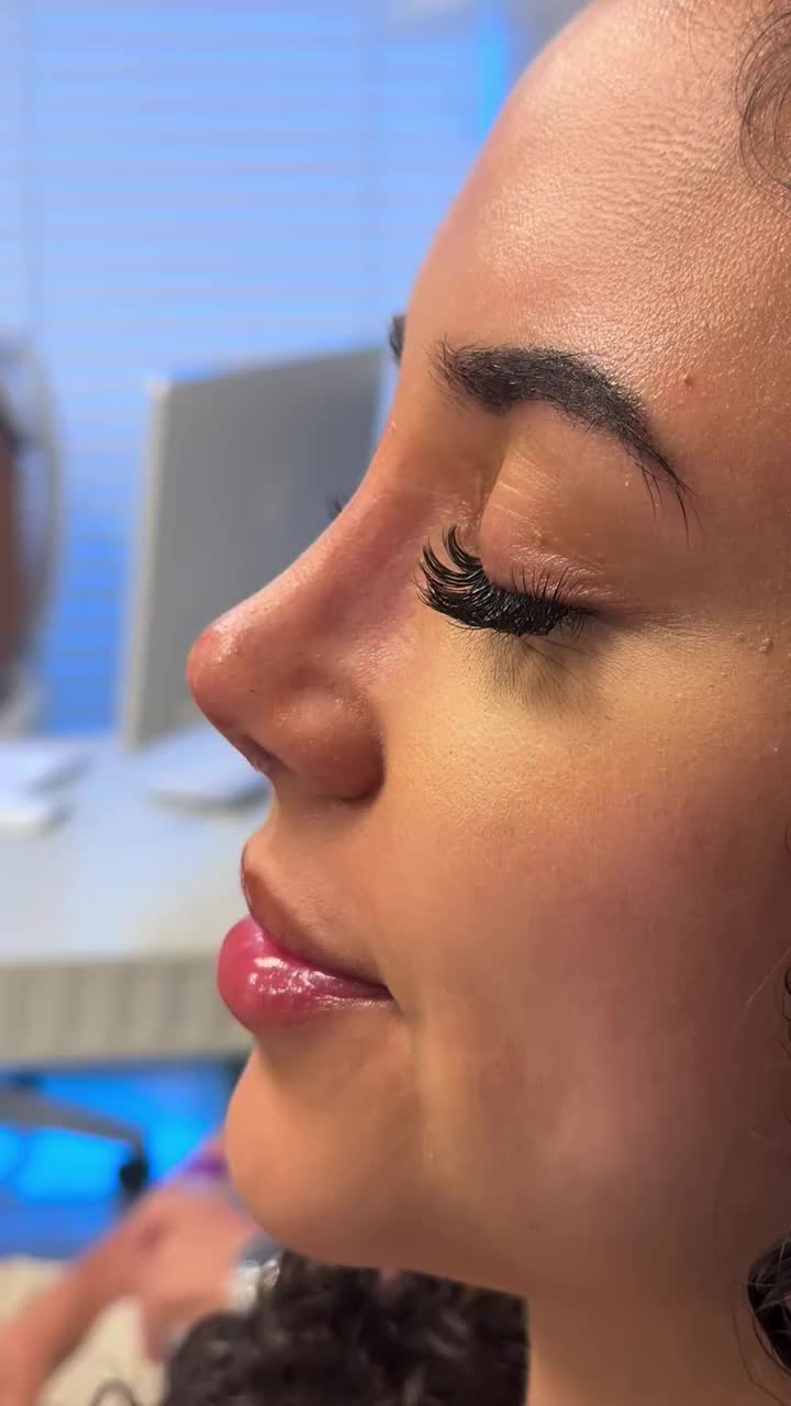 @Lor Cərrah Rinoplastika🌸✅