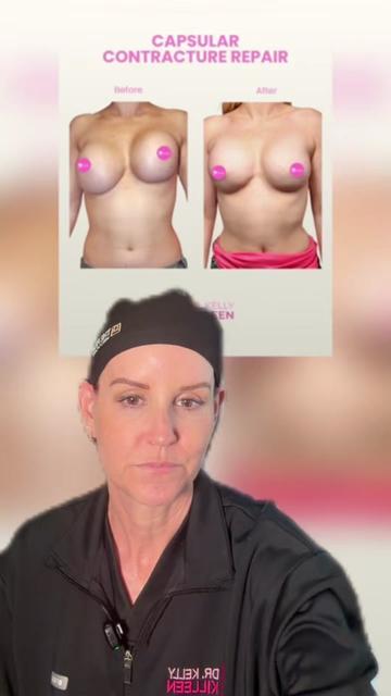 @Kelly Killeen, MD, FACS