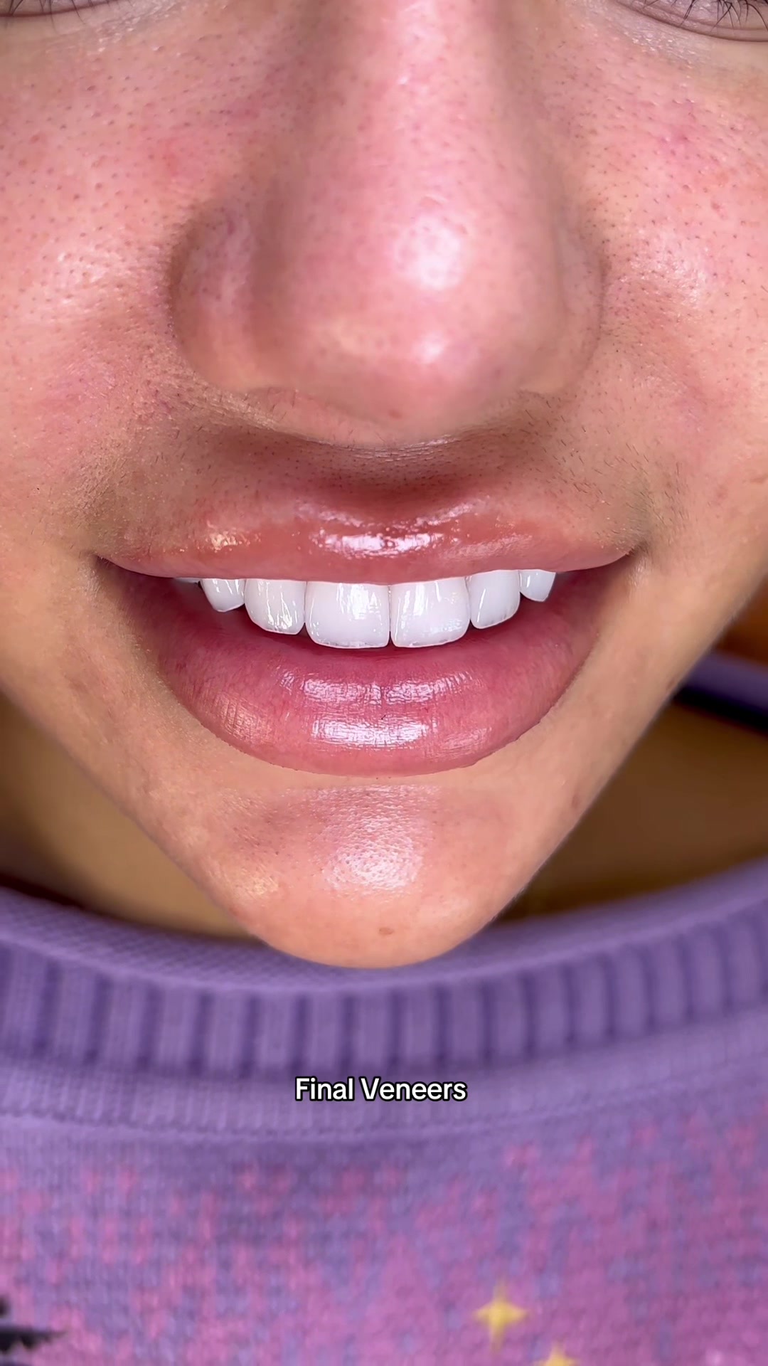@Veneers