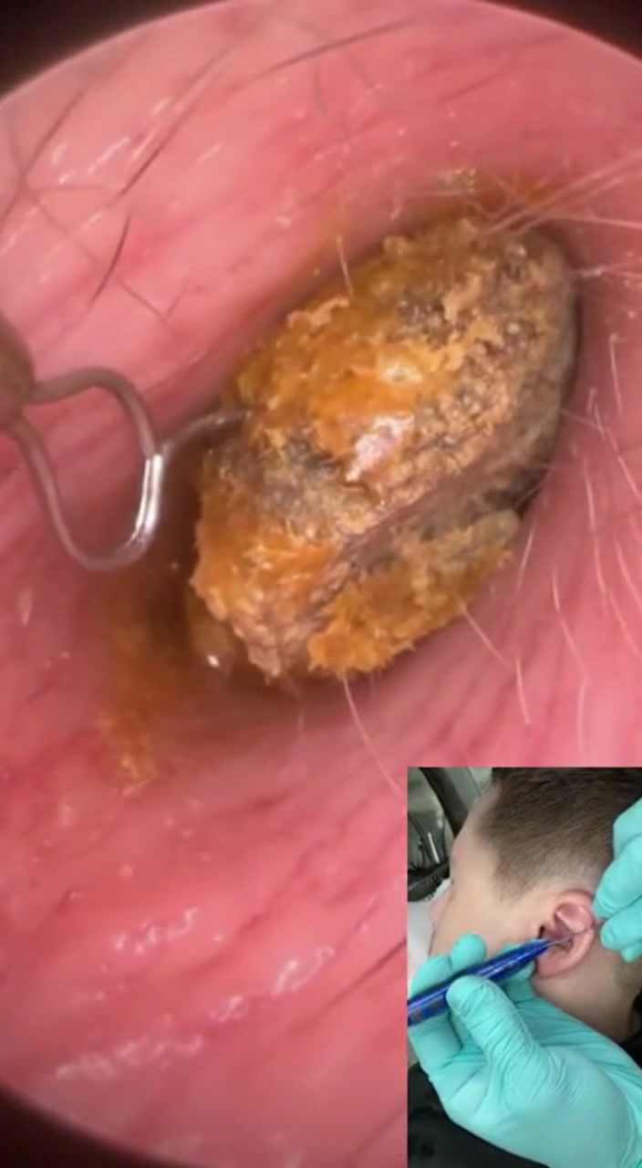 @Ear Cleaning