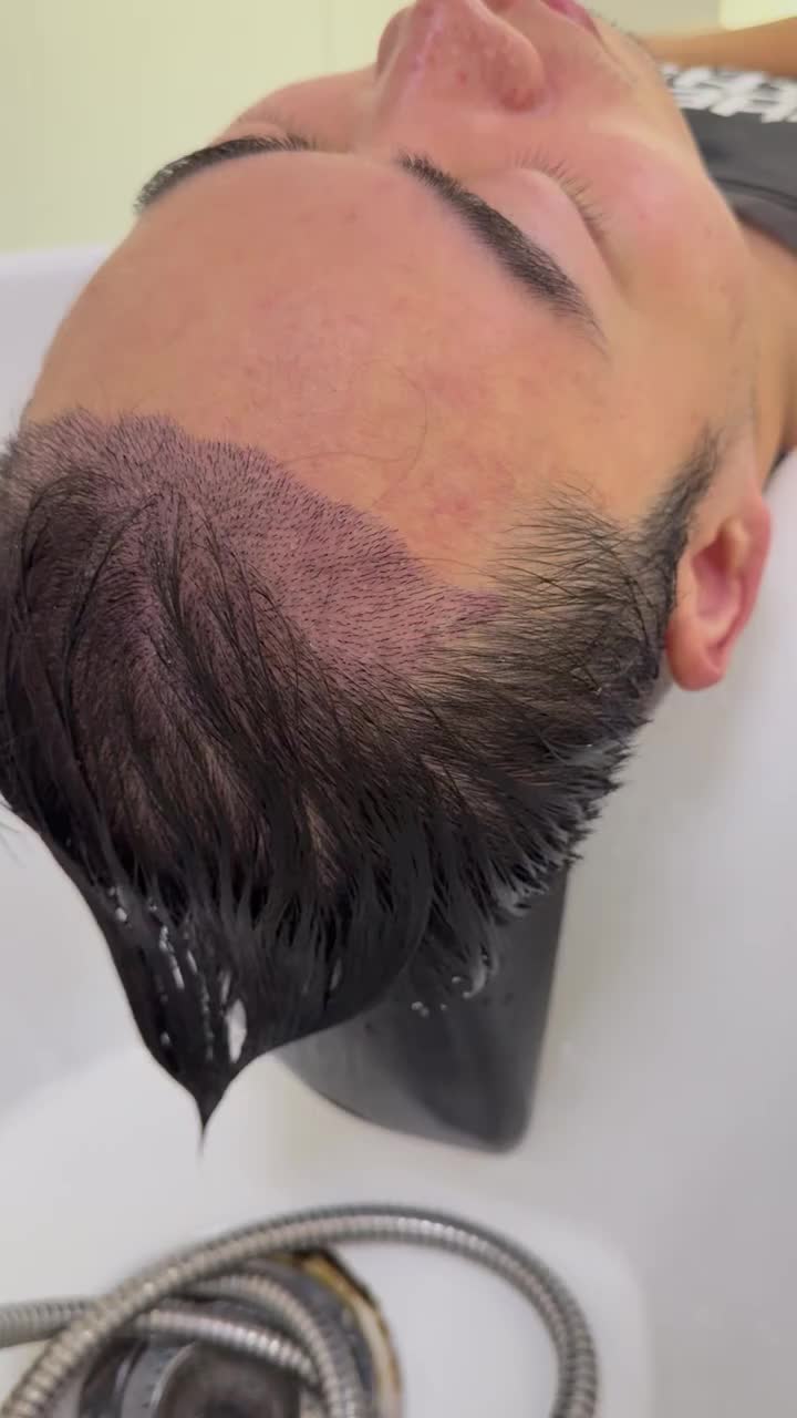 @HAIR TRANSPLANT WANG🇨🇳