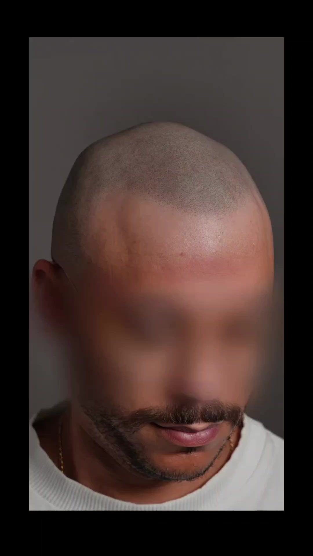 @Enhanced Scalp
