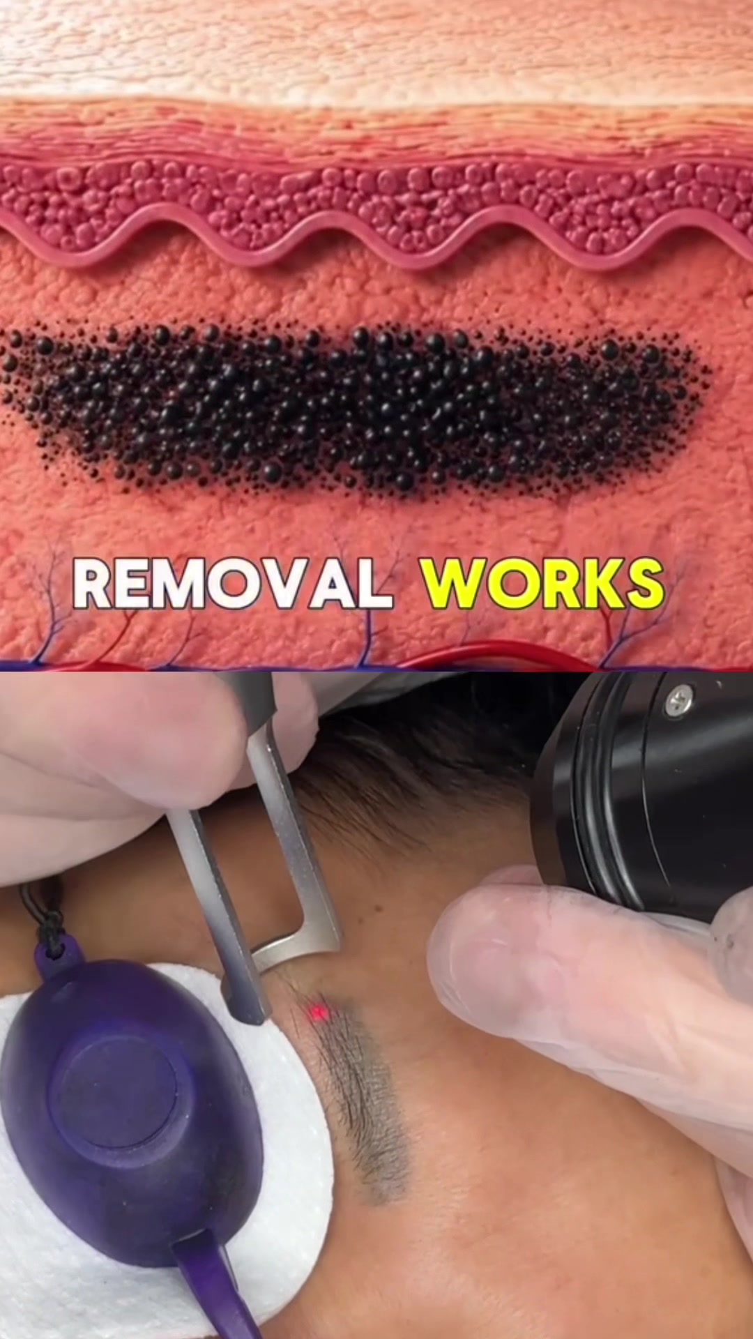 @Safe Eyebrows Tattoo Removal🗽