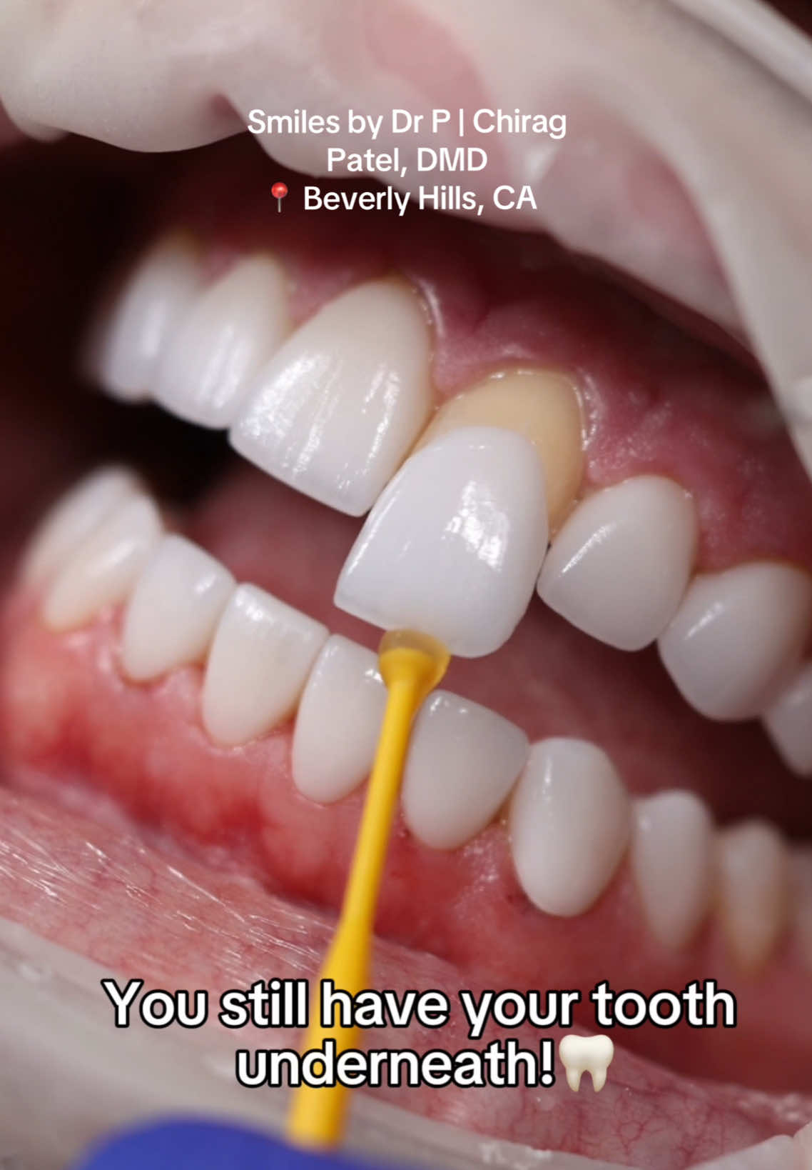 @Veneers