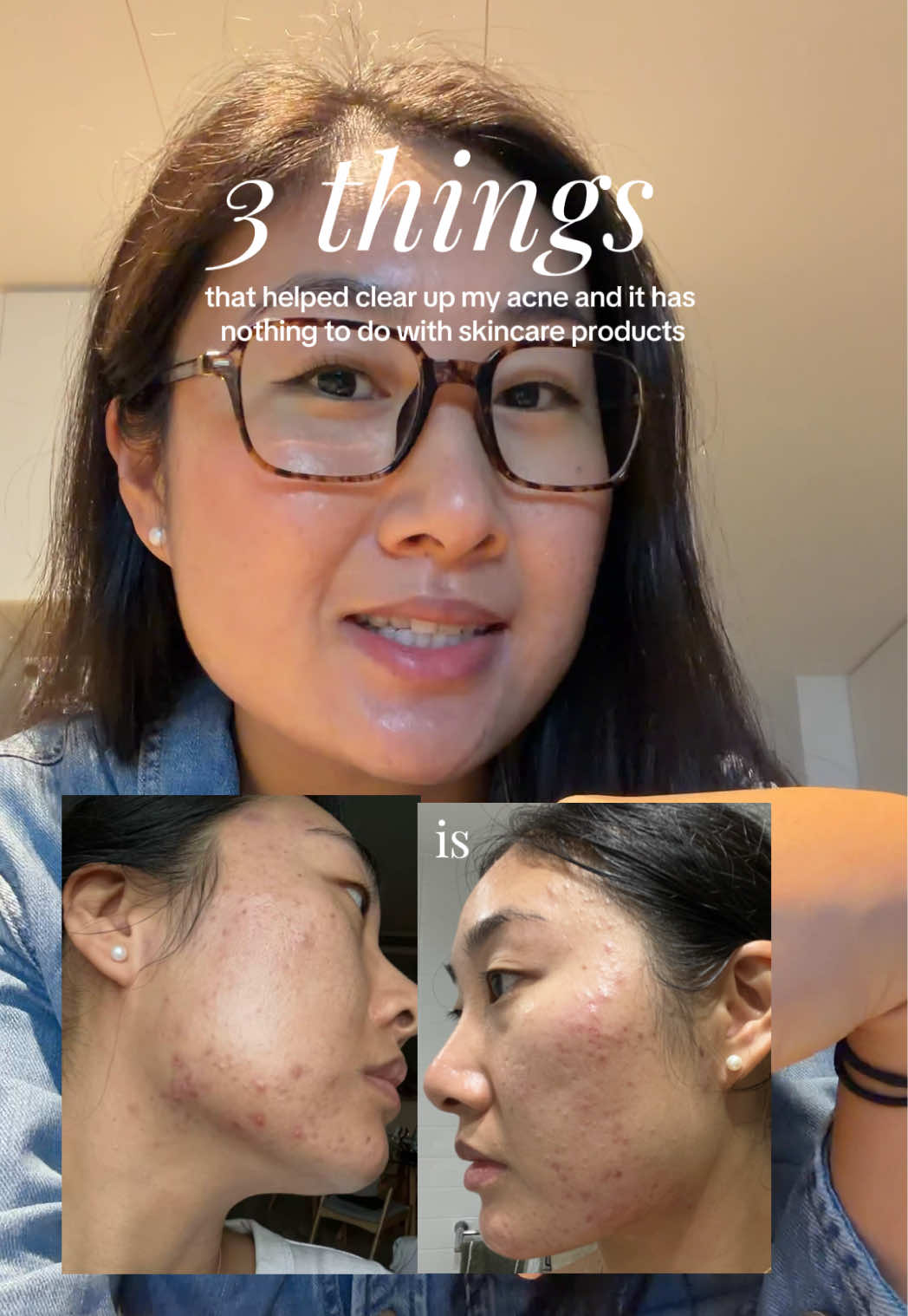 @Lisa | acne → clear skin