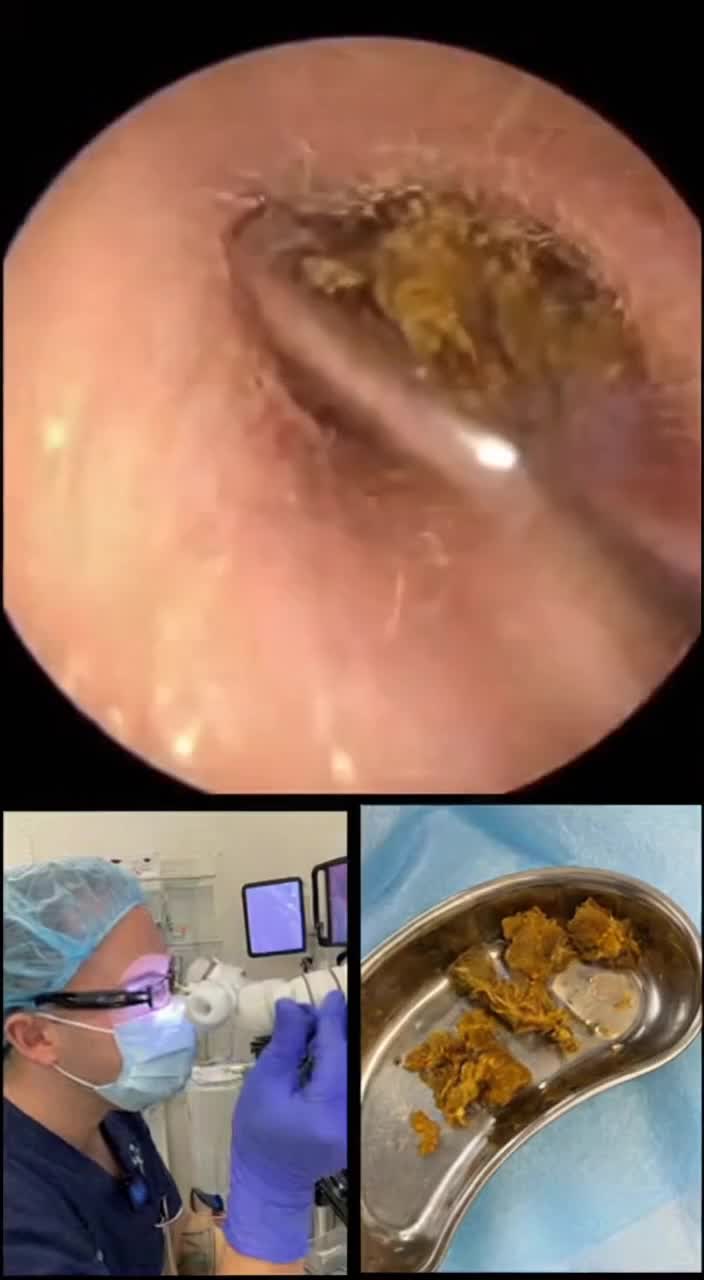 @Ear Cleaning