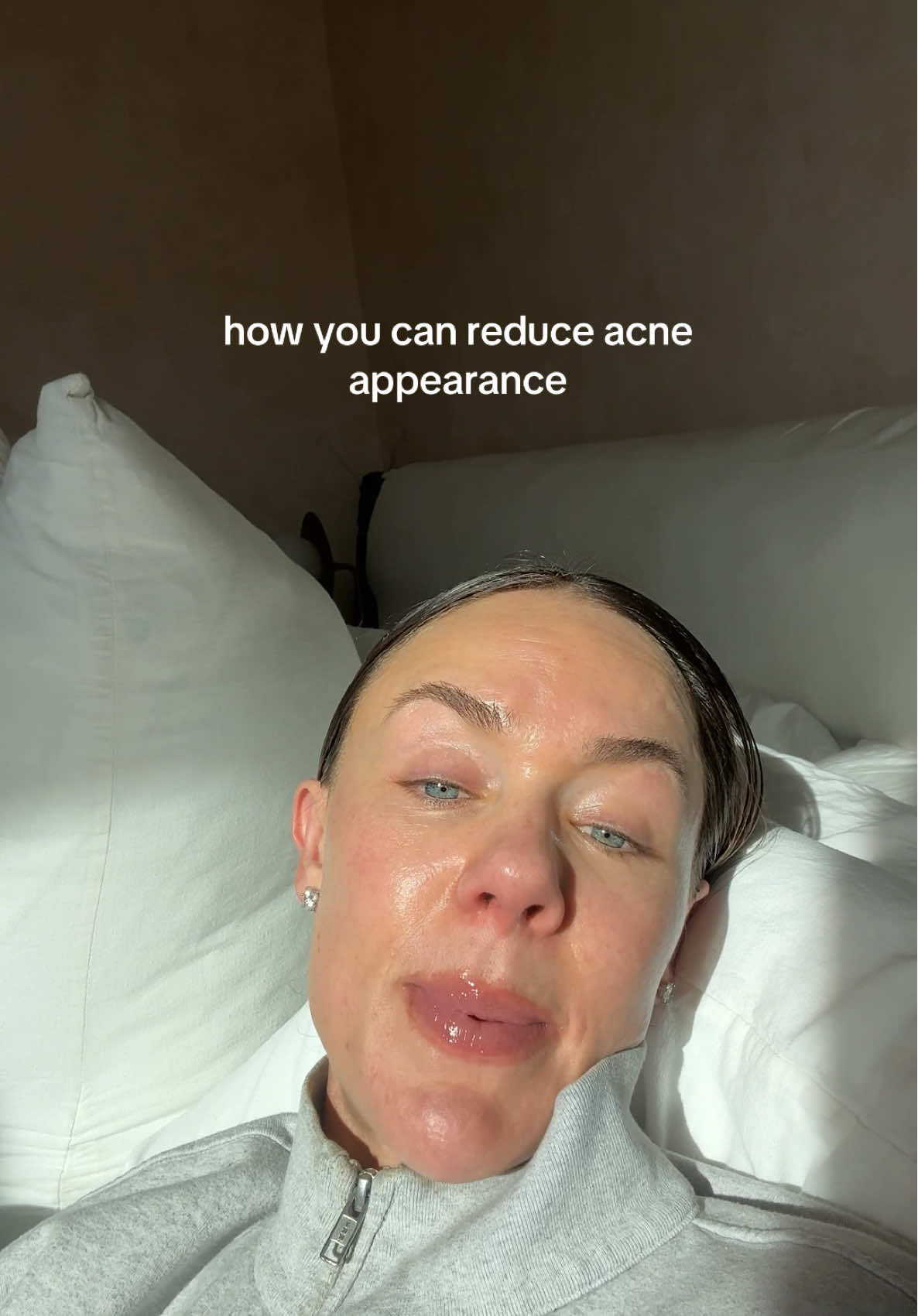 @Celeste | RN acne expert
