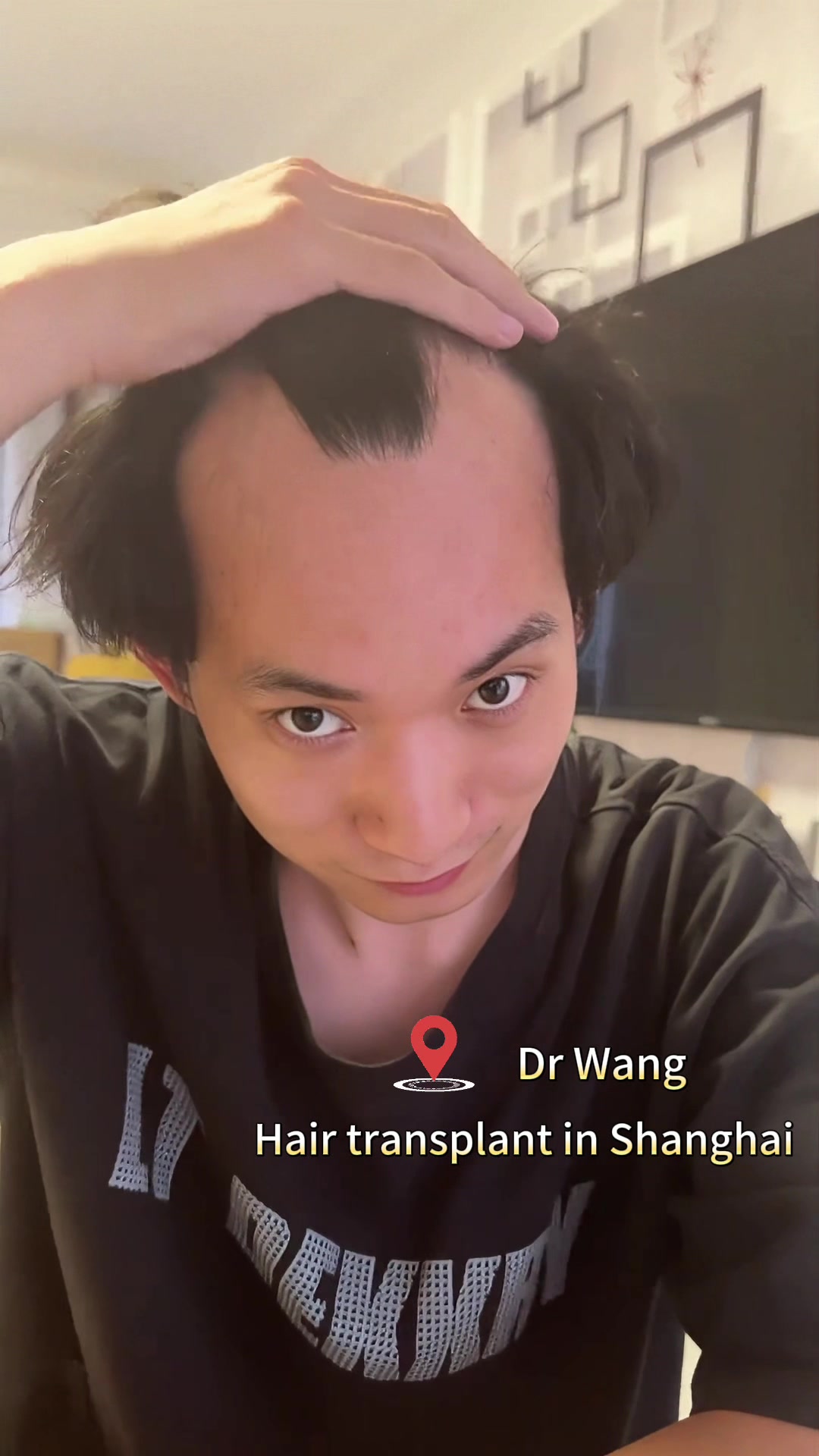 @HAIR TRANSPLANT WANG🇨🇳