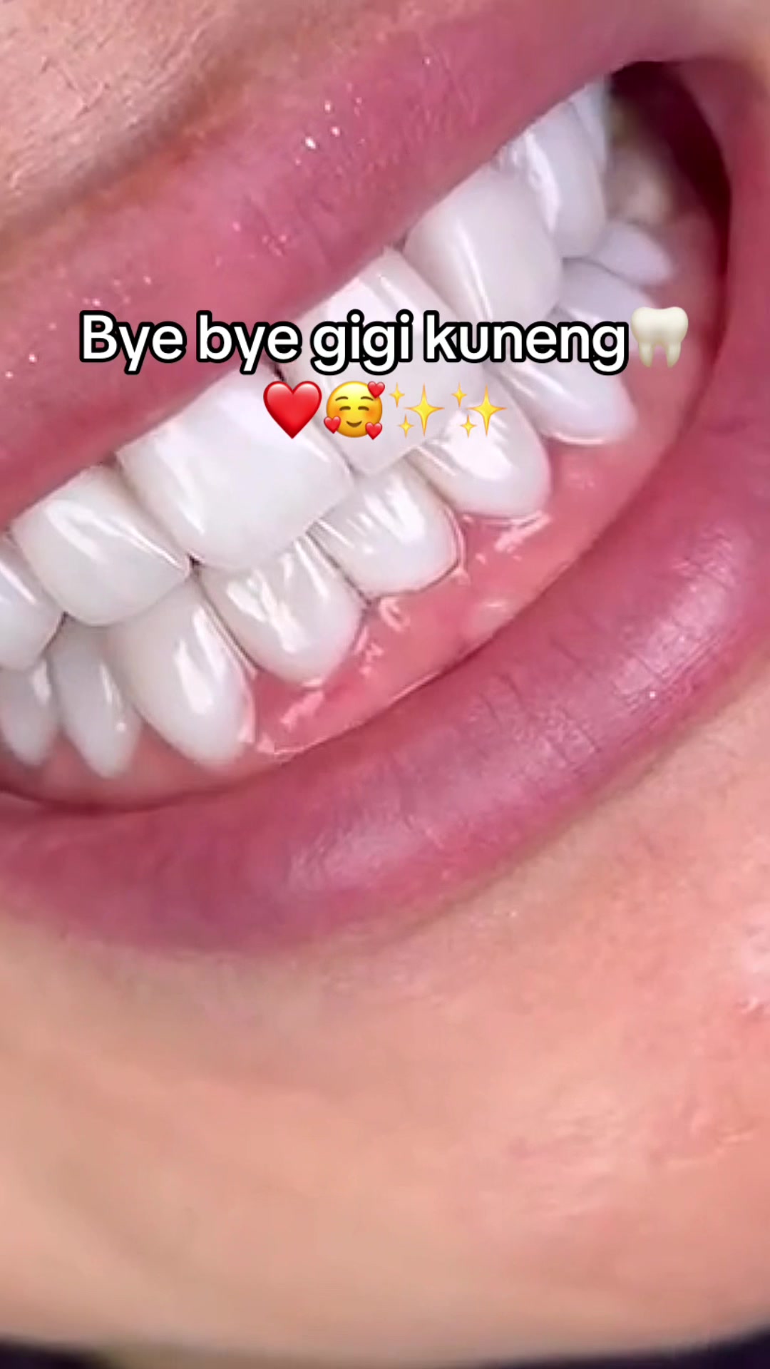 @Gigi Putih Berkilau🦷✨