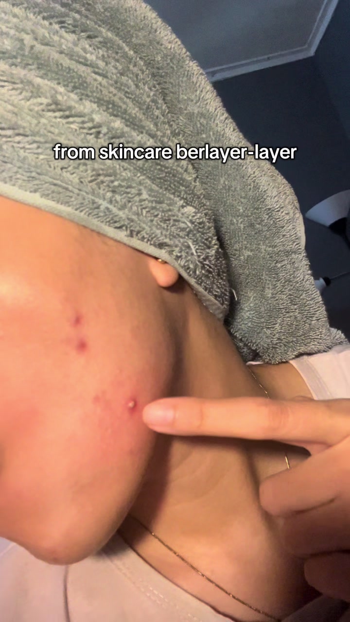 @Acne Fighter
