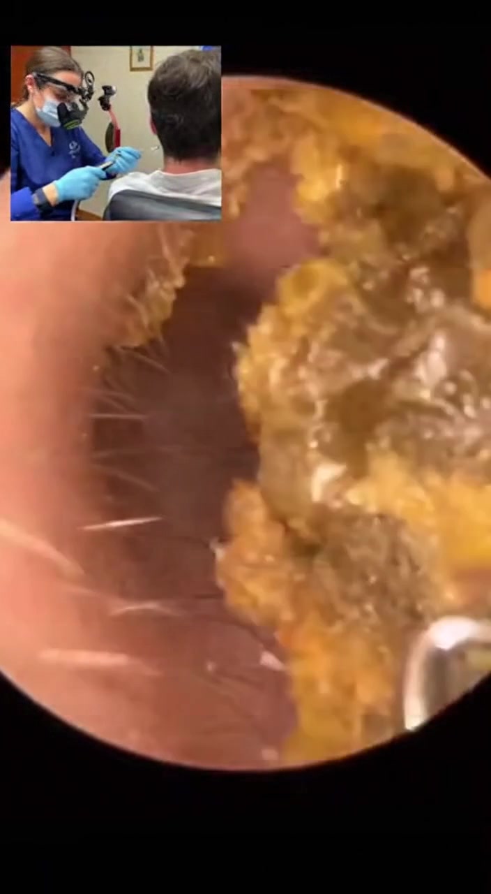 @Ear Cleaning