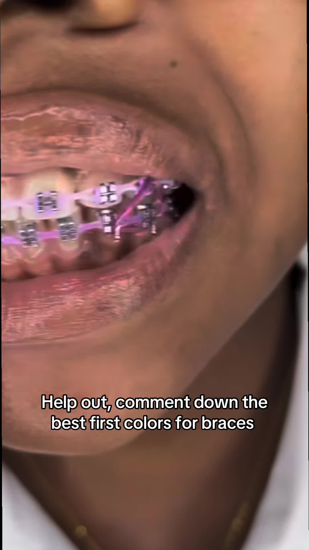 @bracesjunkie
