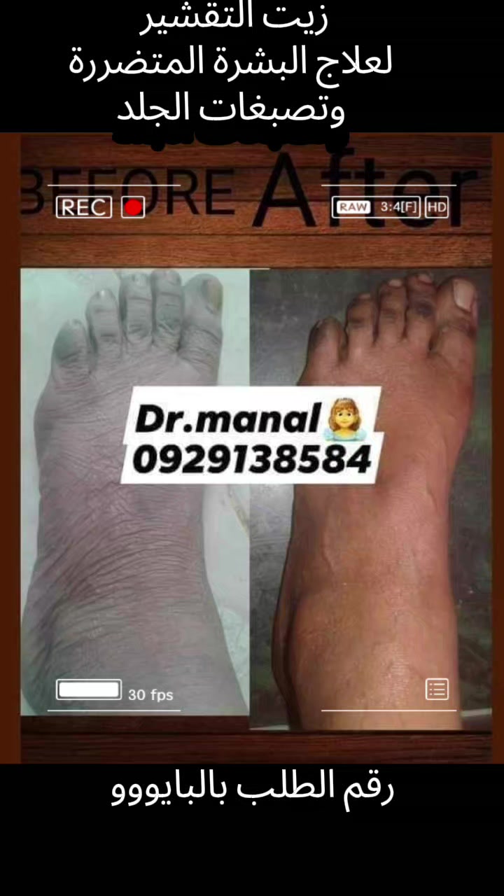 @drmanal " لعلاج التشققات "