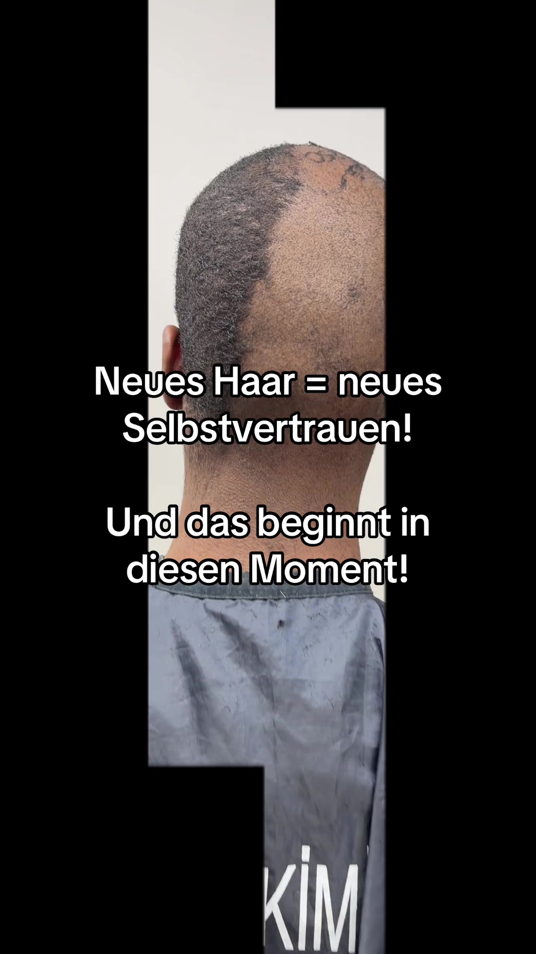 @Mr. Hairtransplant